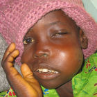 A Nigerian girl with Burkitt's lymphoma